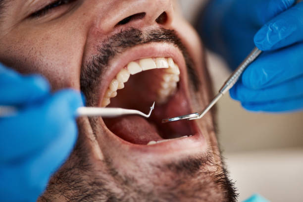 Dental Bonding in Marysville, CA